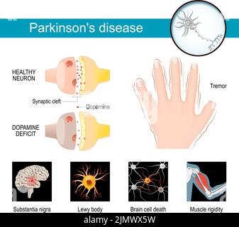 Infografik zur Parkinson-Krankheit. Gesunde Neurone und synaptische Spalte mit Dopamindefizit. Symptome eines Parkinsonismus. Zittern oder Händeschütteln. Muskel Stock Vektor