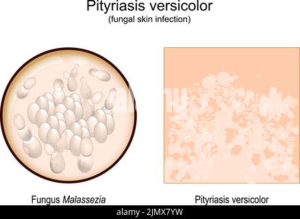 Pityriasis versicolor. Hautoberfläche mit Anzeichen und Symptomen von Tinea versicolor. Nahaufnahme eines Malassezia-Pilzes, der zu Hautausbrüchen führte. vector Stock Vektor