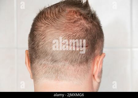 Ein großer Kratzer auf dem Kopf eines Mannes, der den Kopf auf eine Ecke im Pool fallen ließ, eine Wunde, die seinen Kopf traf, Medikamente und Notfallversorgung Stockfoto