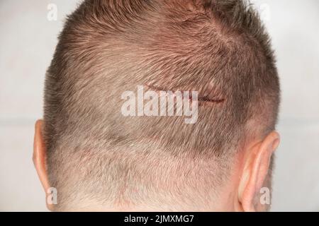 Ein großer Kratzer auf dem Kopf eines Mannes, der den Kopf auf eine Ecke im Pool fallen ließ, eine Wunde, die seinen Kopf traf, Medikamente und Notfallversorgung Stockfoto