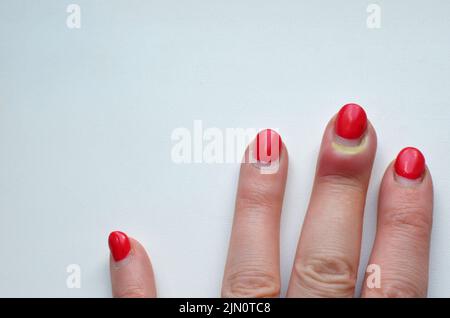 Geschwollene gerötete Finger an der Hand mit Infektion, Eiter nach Maniküre. Stockfoto