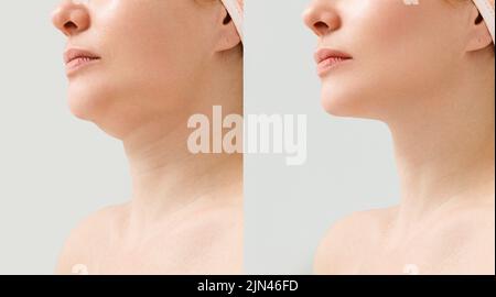 Weibliches Doppelkinn vor und nach der Korrektur. Korrektur der Kinn Form Fettabsaugung des Halses. Das Ergebnis des Eingriffs in der Klinik von Stockfoto