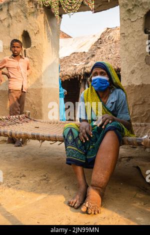 Filariasis ist eine infektiöse Tropenkrankheit, die durch einen von mehreren Fäden wie parasitäre Rundwürmer verursacht wird. Stockfoto