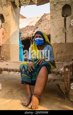 Filariasis ist eine infektiöse Tropenkrankheit, die durch einen von mehreren Fäden wie parasitäre Rundwürmer verursacht wird. Stockfoto