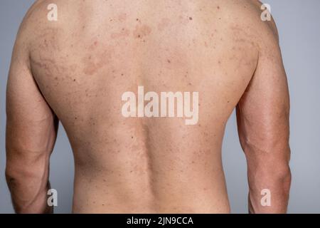 Tinea versicolor auf dem Rücken. Pityriasis versicolor Problem mit der ...