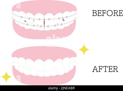 Illustration der ästhetischen Zahnheilkunde und Kieferorthopädie: Verzerrte und schöne Zahnanordnung, mit Metallhalterung Stock Vektor