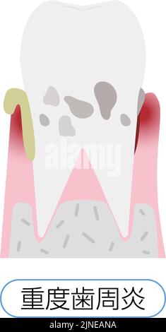 Illustration nach Stadium der Parodontitis: Schwere Parodontitis Übersetzung: Schwere Parodontitis Stock Vektor