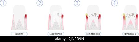 Darstellung des Fortschreitens der Parodontitis, 4 Stufen Übersetzung: Gingivitis, frühe Parodontitis, mäßige Parodontitis, schwere Parodontitis Stock Vektor