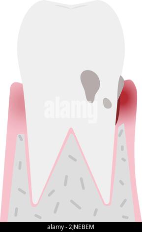 Illustration nach Stadium der Parodontitis: Frühe Parodontitis Stock Vektor
