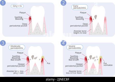 Parodontitis Progression Illustration, 4 Stadien Stock Vektor