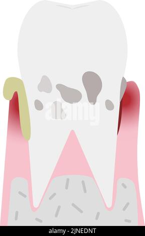 Illustration nach Stadium der Parodontitis: Schwere Parodontitis Stock Vektor