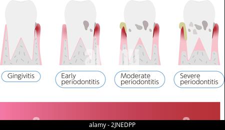 Illustration nach Stadium der Parodontitis: Reihenfolge des Fortschritts Stock Vektor