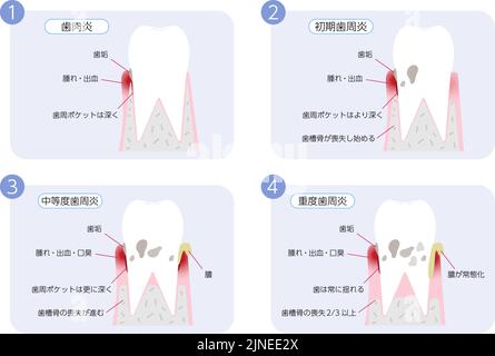 Darstellung des Fortschreitens der Parodontitis, 4 Stufen Übersetzung: Gingivitis, frühe Parodontitis, mäßige Parodontitis, schwere Parodontitis Stock Vektor