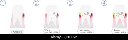 Darstellung des Fortschreitens der Parodontitis, 4 Stufen Übersetzung: Gingivitis, frühe Parodontitis, mäßige Parodontitis, schwere Parodontitis Stock Vektor