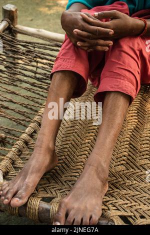 Filariasis ist eine infektiöse Tropenkrankheit, die durch einen von mehreren Fäden wie parasitäre Rundwürmer verursacht wird. Stockfoto