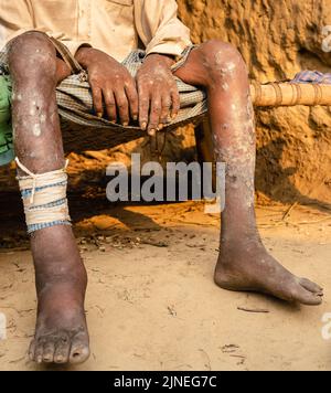 Filariasis ist eine infektiöse Tropenkrankheit, die durch einen von mehreren Fäden wie parasitäre Rundwürmer verursacht wird. Stockfoto