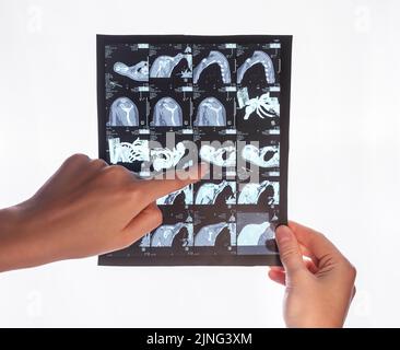 CT. Die Hand zeigt auf das Bild des computergesteuerten Tomographie-Scans. Arzt, der dem Patienten ein medizinisches Problem zeigt. Identifizierung von Krankheiten, Verletzungen. Hoher pH-Wert Stockfoto