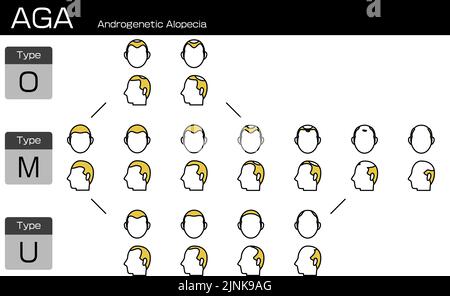 Darstellung jeder Art von AGA-androgenetischer Alopezie und des Fortschrittstadiums Stock Vektor
