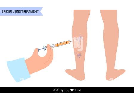 Behandlung der Spinnenvene, Abbildung Stockfoto