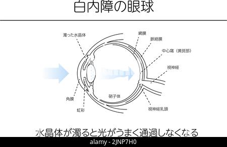 Illustration, Katzenauge, Medizinische Illustrationen. - Übersetzung: Katarakt Auge, trübe Linse verhindert, dass Licht durch richtig, trübe Linse passieren. Stock Vektor