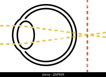 Medizinische Illustration von Sehschärfe und refraktiver Störung, Hyperopie (Fokus hinter der Netzhaut) Stock Vektor