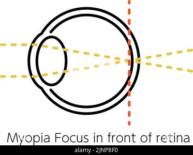 Medizinische Illustration von Sehschärfe und refraktiver Störung, Orthopädie (Fokus auf der Netzhaut) Stock Vektor