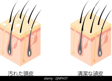 Diagrammatische Darstellung eines Querschnitts einer schmutzigen und einer sauberen Kopfhaut, isometrisch - Übersetzung: Schmutzige Kopfhaut, saubere Kopfhaut Stock Vektor