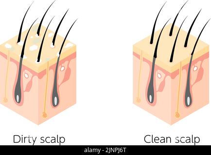 Diagrammatische Darstellung eines Querschnitts einer schmutzigen und einer sauberen Kopfhaut, isometrisch Stock Vektor