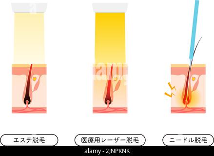 Bild von Haarentfernung, ästhetische Haarentfernung, Medizinische Laser-Haarentfernung, Nadelhaarentfernung - Übersetzung: Ästhetische Epilation, Medizinische Laser-Epilation Stock Vektor