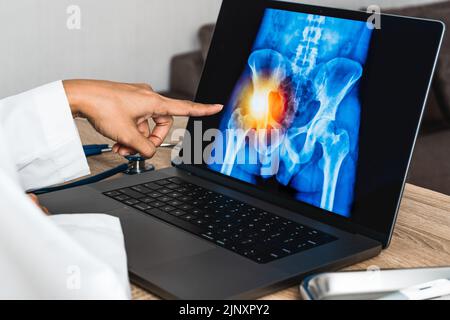 Nahaufnahme eines Arztes, der eine Röntgenaufnahme der Schmerzen in den Hüften auf einem Laptop zeigt. Stockfoto