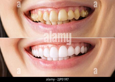 Das Lächeln einer Frau in Nahaufnahme, vor und nach dem Bleichen beim Zahnarzt, Stockfoto