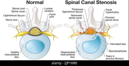 Abbildung zeigt Spinalkanalstenose Lendenwirbel mit Bandscheibe und einem Zellherniversum pulposus Stockfoto