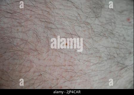 Ein einzelnes Sommersprossen, isoliert auf einem mit Haaren bedeckten Bein Stockfoto