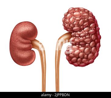 Chronische Nierenerkrankung oder CKD als menschliche Nieren Konzept als eine gesunde und polyzystische Erkrankung mit Zysten als Anatomie des Harnsystems. Stockfoto