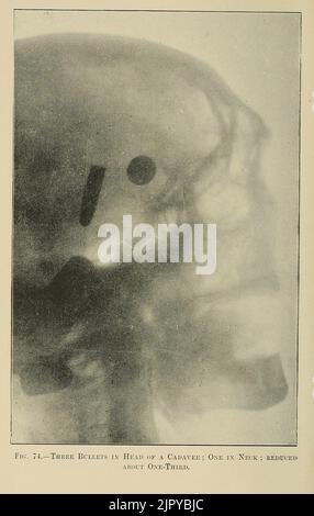 Drei Kugeln im Kopf eines Kadavers, aus den Röntgenstrahlen in der medizinischen Arbeit extrahiert (1907) Stockfoto