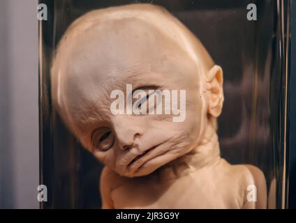 Probe des menschlichen Förses mit anatomischen Anomalien in einem Glas Formaldehyd in einem Schrank mit Kuriosen aus der Nähe. Stockfoto