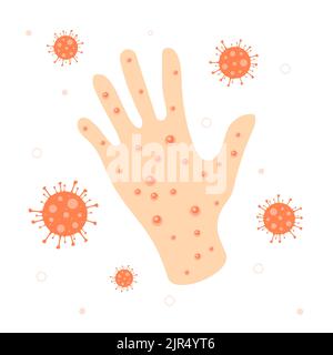 Akne auf der Hand von monkeypox Stock Vektor