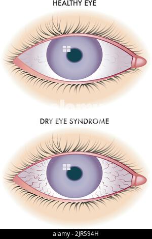 Die symbolische medizinische Illustration zeigt ein gesundes und ein vom Trockenen-Auge-Syndrom betroffenes Auge. Stock Vektor