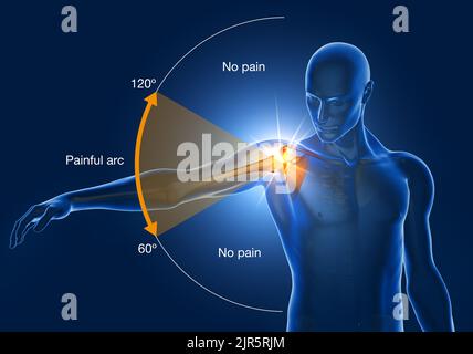 Abbildung mit Schulteraufschlag, schmerzvoller Bogen, 3D Abbildung Stockfoto