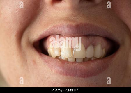 Schiefe gelbe Zähne eines jungen Mädchens aus der Nähe, offen wachsend mit schlechten Zähnen zum Beispiel, Zähnen und Mund, Karies Stockfoto