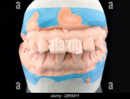 Gipsguss-Modell auf schwarzem Hintergrund. Nahaufnahme der Zahnputzform des Zahnarztes. Vorderansicht. Selektiver Fokus. Unterkiefer und Oberkiefer aus Metall Stockfoto