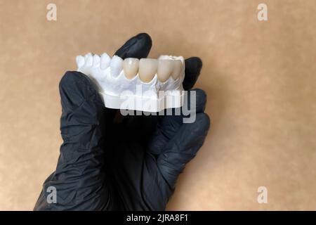 Gipsmodell mit falschen Keramik- oder Porzellanzähnen in der Hand des Zahnarztes in schwarzem Handschuh. Konzept der Zahnprothese und Zahngesundheit. Selektiv Stockfoto