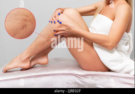 Fit Woman sitzt und zeigt vaskuläre Sternchen auf ihrem Unterschenkel. Seitenansicht. Vergrößerter Bereich mit Blutgefäßen. Das Konzept der Krampfadern und Krampfadern Stockfoto