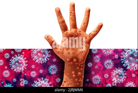Monkeypox Virus Ausbruch als ansteckende Infektion als Blasen und Gifte auf der Haut, die die Übertragung einer infizierten Person. Stockfoto