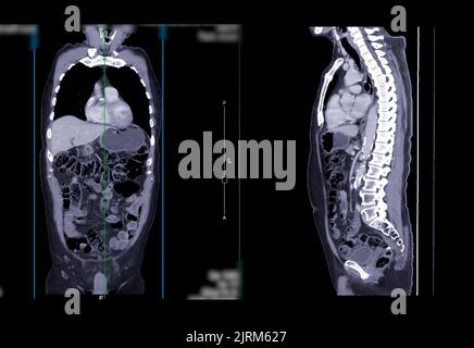 CT-SCAN von Brust- und Abdomen koronale und sagittale Ansicht mit Injektionskontrastmedien für Diagnonsen bei Brust- und Abdomen-Erkrankungen. Stockfoto