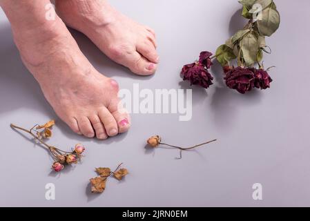 Konzept der Fußkrankheit bei alter Frau mit trockenen Blumen. Stockfoto