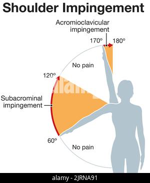 Abbildung zeigt das Schulter-Impingement-Syndrom und den schmerzhaften Lichtbogen Stockfoto