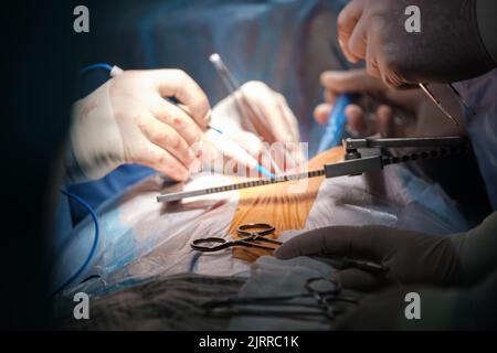 Nahaufnahme der Hände eines professionellen Arztes, die einen Patienten während einer Operation am offenen Herzen im Operationssaal operieren. Konzept der Gesundheitsversorgung und medizinischen Intervention Stockfoto