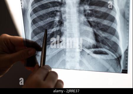 Arzt zeigt Röntgenaufnahme der Lunge des Patienten. Stockfoto