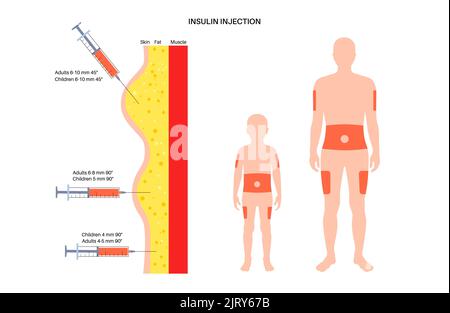 Insulin-Injektionsstellen, Abbildung Stockfoto
